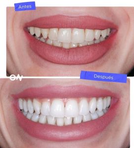 BLANQUEAMIENTO COMBINADO