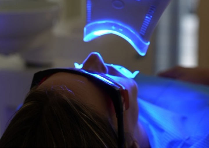 Blanqueamiento dental madrid